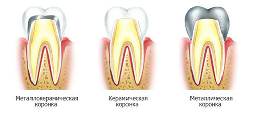 Виды искусственных зубов